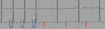 Figura 3 – Eletrocardiograma com BAV de 2º grau Mobitz 2. Intervalos PR constantes antes da onda p não conduzida 