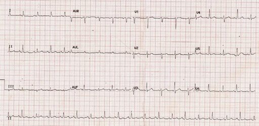 Na imagem do ecg vemos as características clássicas do derrame pericárdico: baixa amplitude do QRS em algumas derivações associado a alternância de amplitude do QRS.