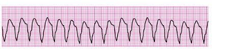 Confira a imagem 1 associada à taquicardia ventricular sem pulso!