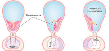 Diferença entre placenta prévia total e placenta de inserção baixa