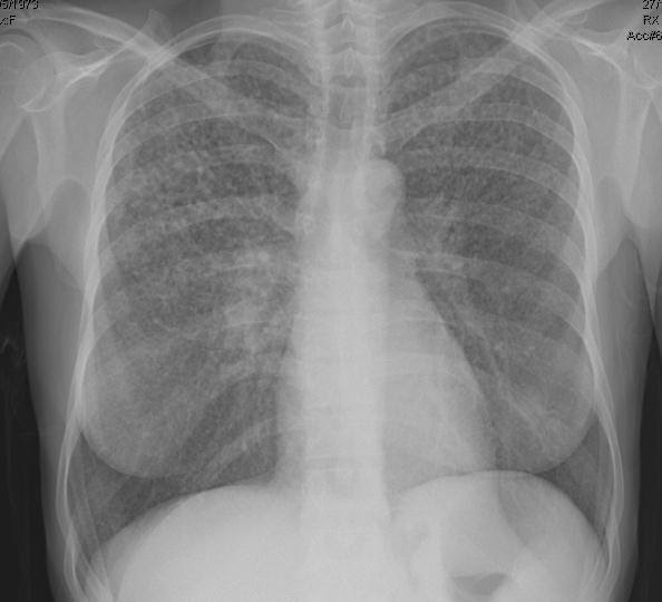Tomografia de tórax de tuberculose miliar.