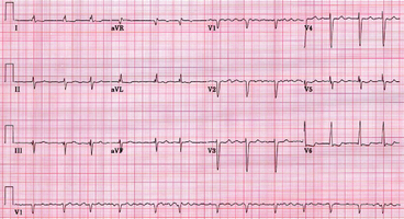 Fibrilação atrial, mais um tipo de taquiarritmia contemplada pelo protocolo de taquiarritmias do ACLS 