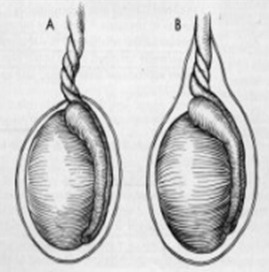 Imagem ilustrativa de torção testicular.