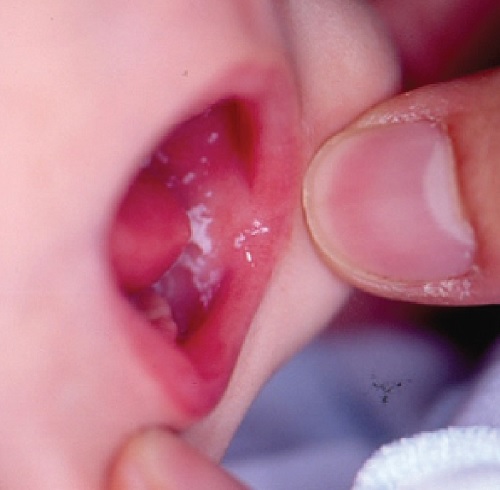 Criança com sintoma de monilíase