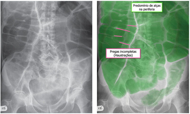Radiografia de abdome em decúbito dorsal demonstrando distensão de alças cólicas.