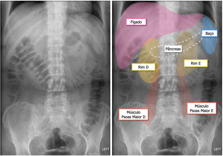 Radiografia em incidência frontal (decúbito dorsal).