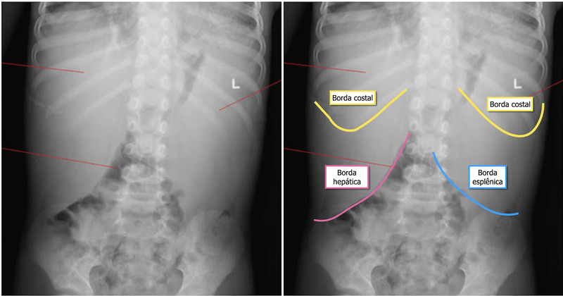 Radiografia de abdome em decúbito dorsal demonstrando hepatoesplenomegalia. 