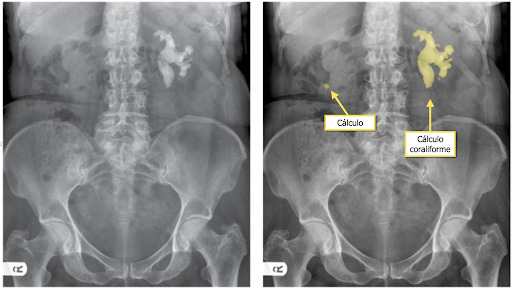 Radiografia de abdome em decúbito dorsal demonstrando cálculo coraliforme no rim esquerdo e cálculo calicinal no rim direito.