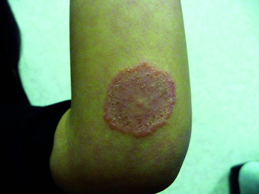 Figura 5. Tinea corporis (dermatofitose corporal)