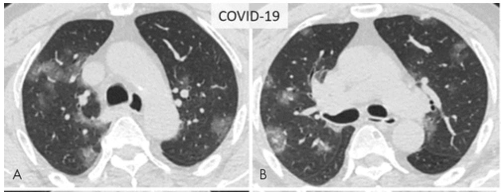 Manifestações tomográficas típicas da COVID-19.