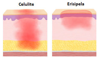 Como a celulite e erisipela se comportam na derme.