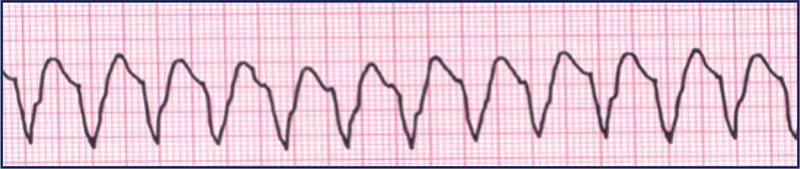 Taquicardia ventricular sem pulso. Fonte: PALS