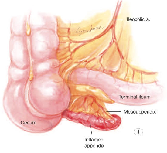 esquema ilustrativo da anatomia do apêndice, mesoapêndice, ceco e irrigação proveniente da artéria ileocólica.