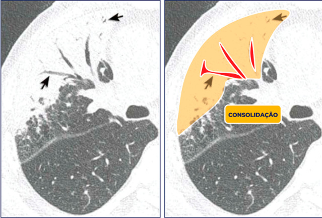 área de consolidação com presença de broncograma aéreo no seu interior relacionado a pneumonia