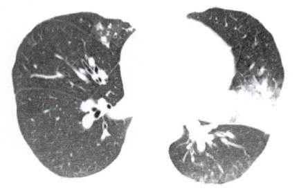 Consolidação periférica (circundada em azul) com vidro fisco circunjcante, situada na língula pulmonar. Associam-se nódulos centro lobulares (circundada em roxo) no lobo médio.