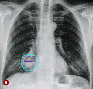 Lesão cavitada, arredondada com nível líquido situada no lobo inferior direito, associada a pneumonia.