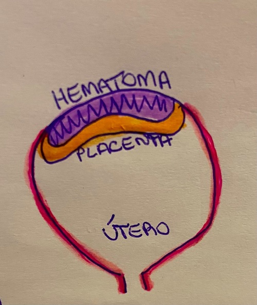 Esquema mostrando o descolamento prematuro de placenta