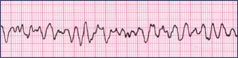 Fibrilação ventricular (FV). Fonte: PALS