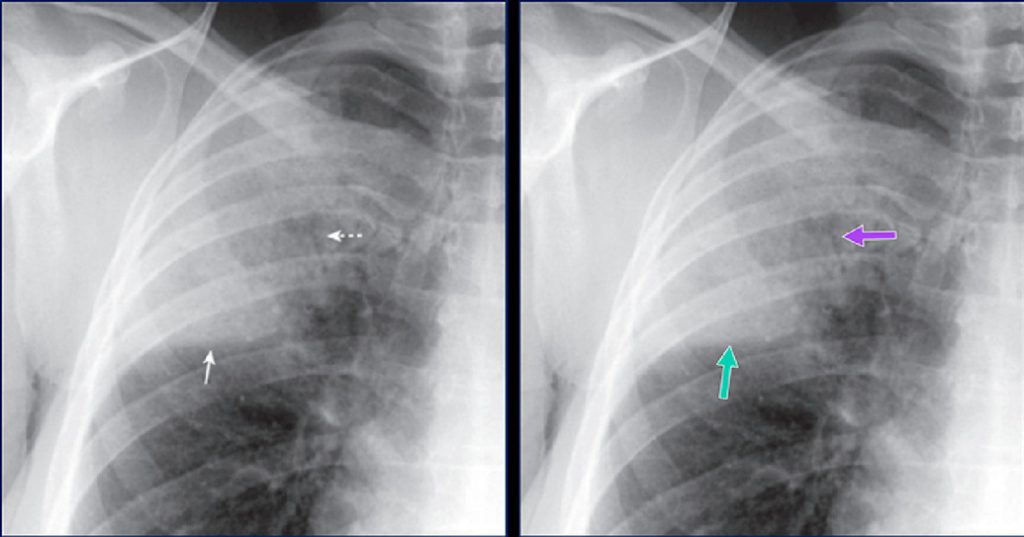 Área de consolidação no lobo superior direito, limitada pela fissura horizontal (seta verde), com broncograma aéreo no seu interior (seta roxa) relacionado a pneumonia