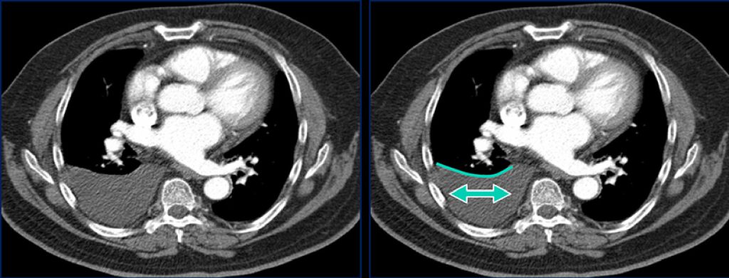 Derrame pleural parapneumônico à direita, localizado posteriormente devido à gravidade.