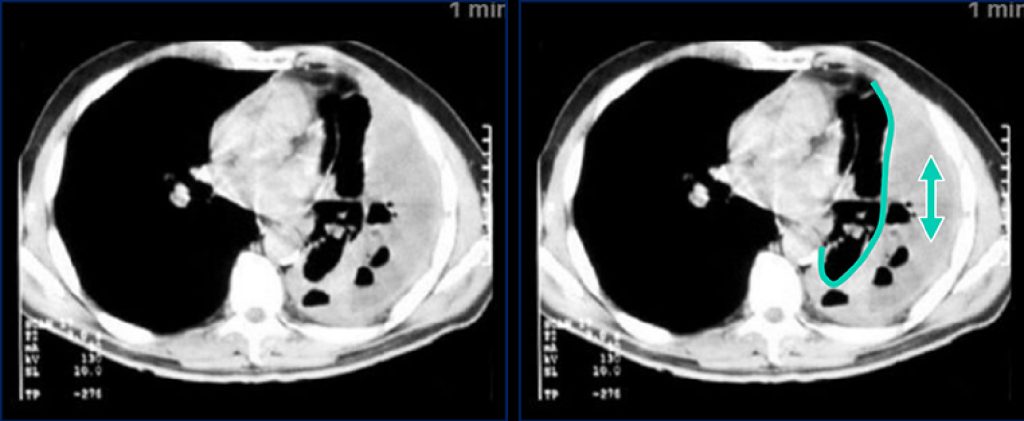 Derrame pleural loculado, caracterizado pela extensão do líquido até a parte anterior do tórax, sendo um provável empiema relacionado a pneumonia.