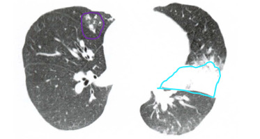 Consolidação periférica (circundada em azul) com vidro fisco circunjcante, situada na língula pulmonar. Associam-se nódulos centro lobulares (circundada em roxo) no lobo médio