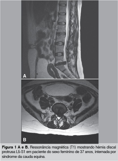 Exemplo de hérnia discal causando uma síndrome da cauda equina aguda.