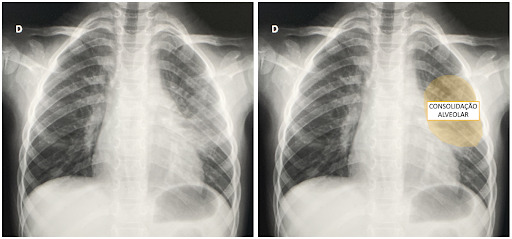 Consolidação alveolar na pneumonia bacteriana.