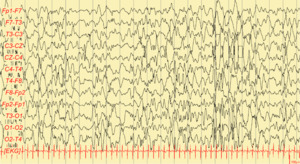 Imagem mostrando Hipsarritmia no eletroencefalograma, um tipo de epilepsia.