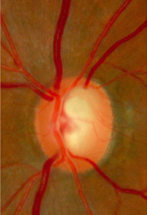 Disco óptico de um paciente com glaucoma moderado