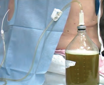 Equipo conectado em frasco coletor para Toracocentese terapêutica em derrame pleural volumoso.