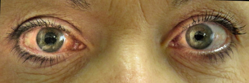 Paciente durante crise de fechamento angular agudo no olho direito. Note a hiperemia ocular e a midríase fixa.