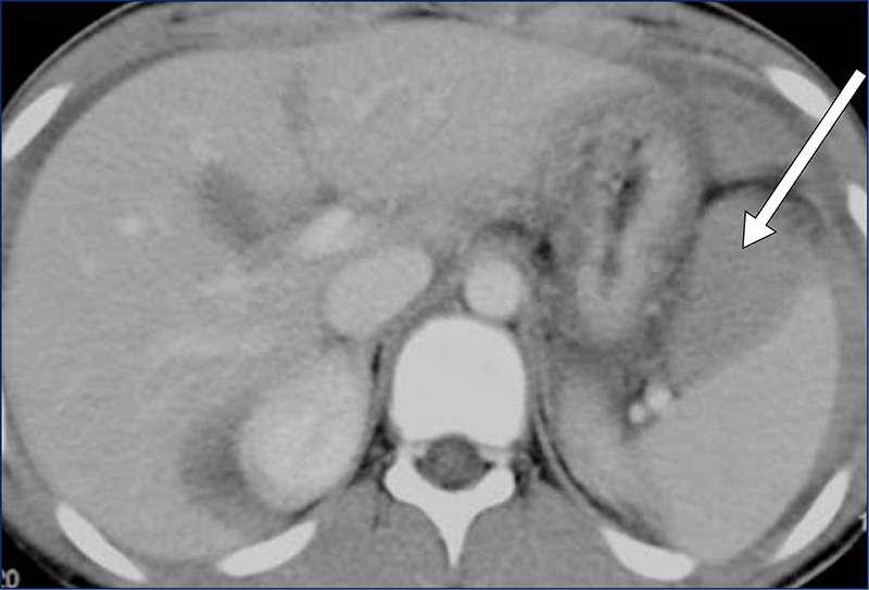 Imagem de hematoma subcapsular.