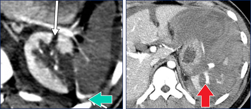 Na imagem da esquerda, notamos que o contraste chega pela artéria esplênica, porém não contrasta o baço, o que representa uma desvascularização total. Além disso, notamos uma lesão renal (seta branca).