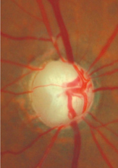 Disco óptico de um paciente com glaucoma avançado