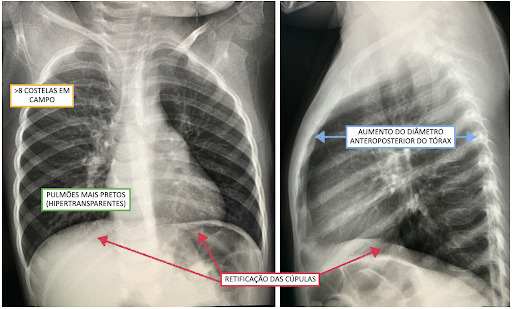 Hiperinsuflação pulmonar na radiografia de tórax.