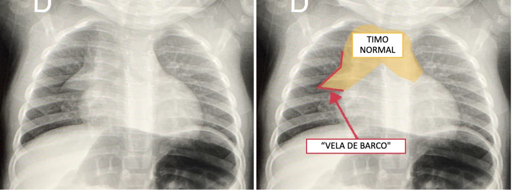 Timo normal da criança na radiografia