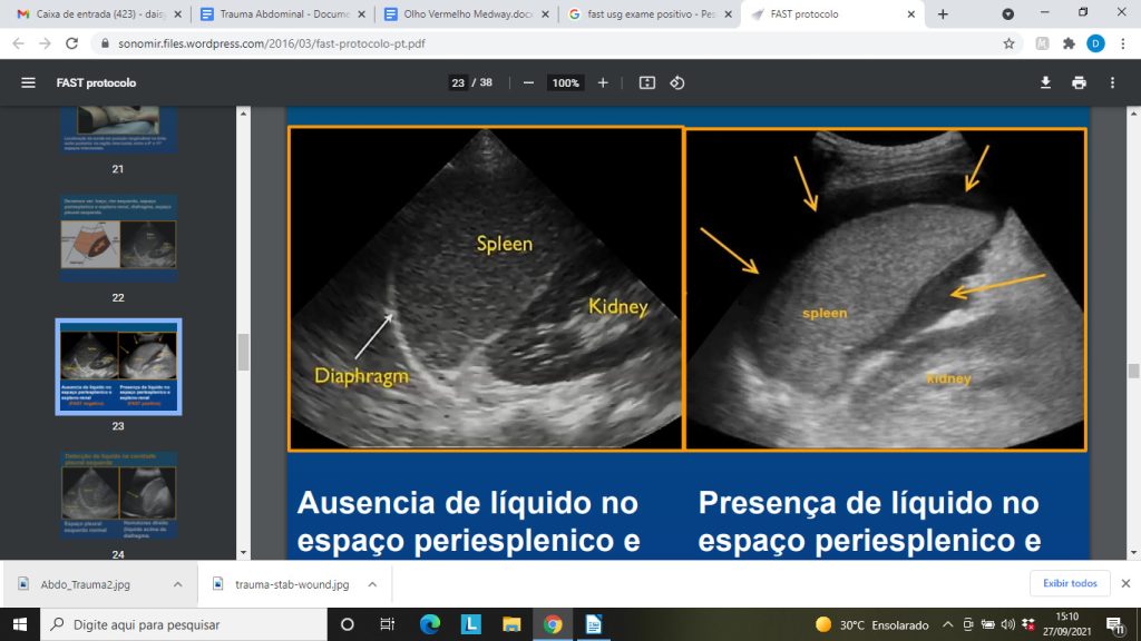 EXPLORACION ABDOMINAL, Notas de estudo de Medicina