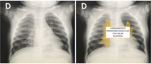 Espessamento peribroncovascular peri-hilar bilateral representando a inflamação das paredes brônquicas.