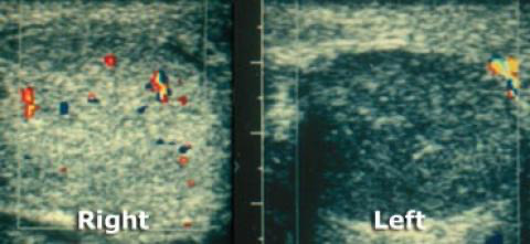 Fluxo presente no testículo direito e ausente no testículo esquerdo, que sofreu torção testicular.