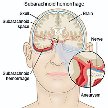 Hemorragia Subaracnoide