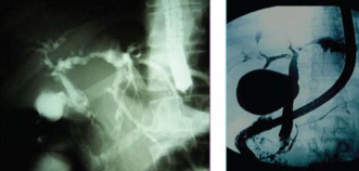 Imagens de colangiografia evidenciando irregularidades nas paredes das vias biliares das vias biliares intra e extra-hepáticas.