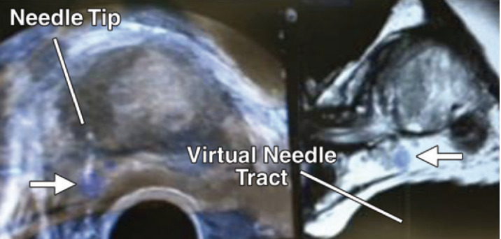 Biópsia da próstata guiada por ultrassonografia com fusão de imagens de RM. A seta mostra a lesão vista na RM (em azul) sobreposta à imagem da ultrassonografia.