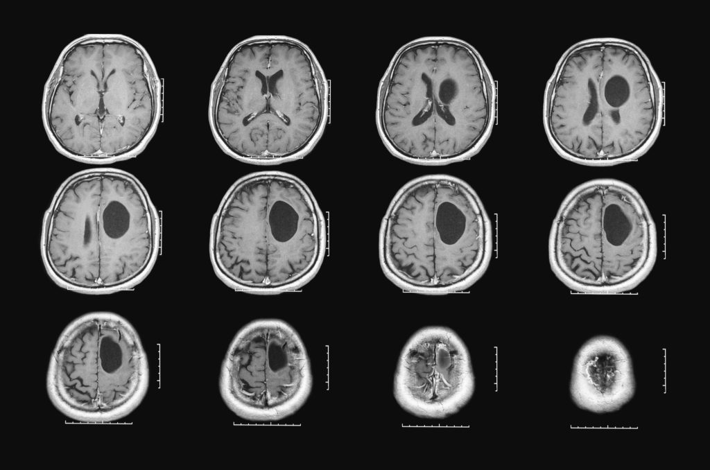 Abscesso cerebral.