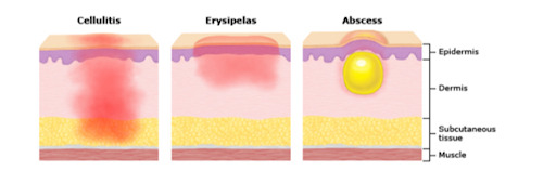 Confira, na imagem, algumas diferenças entre a celulite bacteriana e a erisipela!