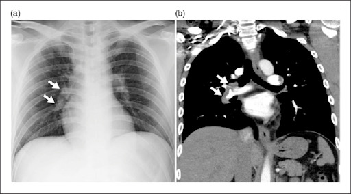 Figura 3 – Sinal de Knuckle: figura 3 associada ao tromboembolismo pulmonar!