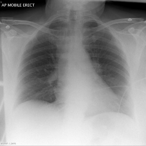 Sinal de Palla: figura 4 associada ao tromboembolismo pulmonar!