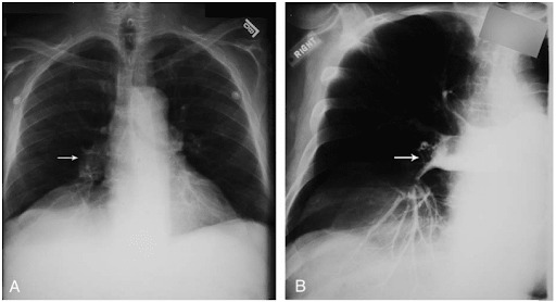 Confira a figura 1 associada ao tromboembolismo pulmonar! (Sinal de Fleischner)