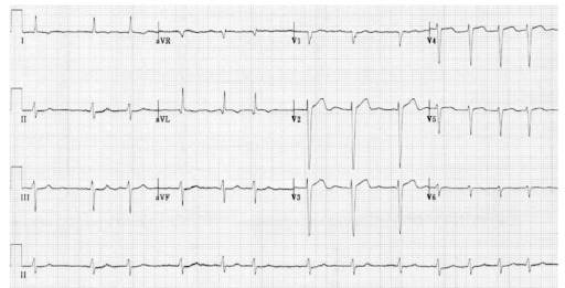 Figura 2 associada à fibrilação atrial. Confira! 