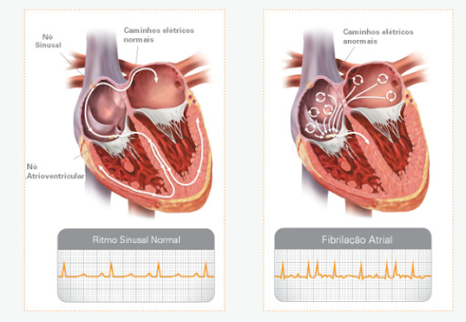 Figura 1 associada à fibrilação atrial. Confira! 